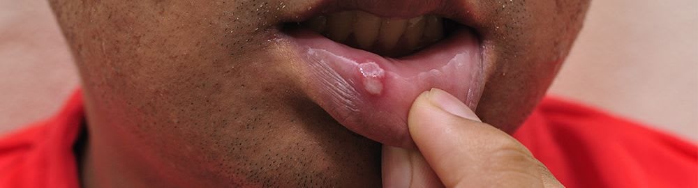 Mouth ulcers