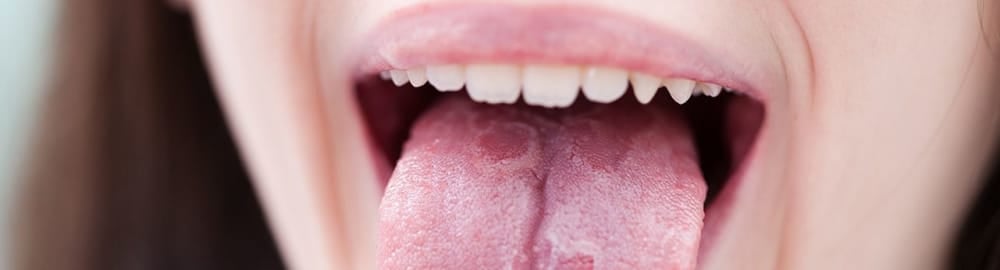 Geographic tongue