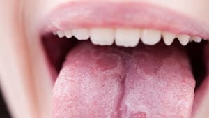 Geographic tongue