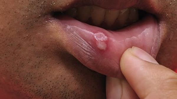 Mouth ulcers