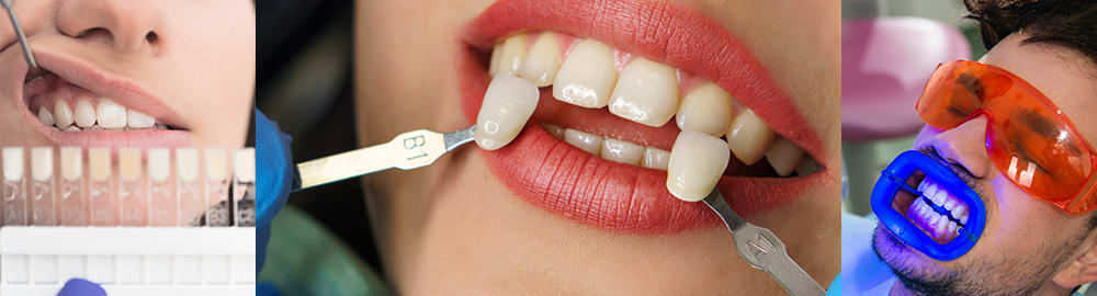 About tooth whitening